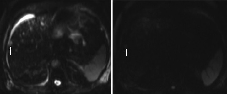 An 81-year-old man with adenocarcinoma of the colon and hepatic lesions later diagnosed as von Meyenburg complex. Diffusion weighted images of the liver at different b-values reveal negative correlation between the signal intensity of the focal liver lesions (arrow) compared to the b-value, in keeping with free diffusion, which favors benign disease.