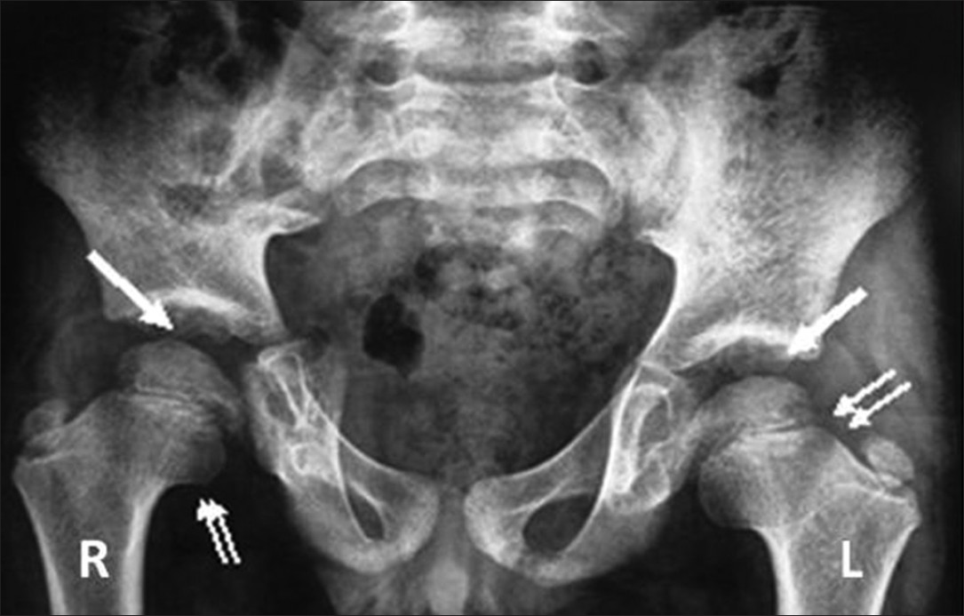 Three-year 3-month-old girl child with CACP syndrome. Anteroposterior radiograph of pelvis shows smooth flattening of femoral heads with irregular acetabulae (arrows). Bilateral femoral necks appeared short and broad with coxa vara (double arrows).