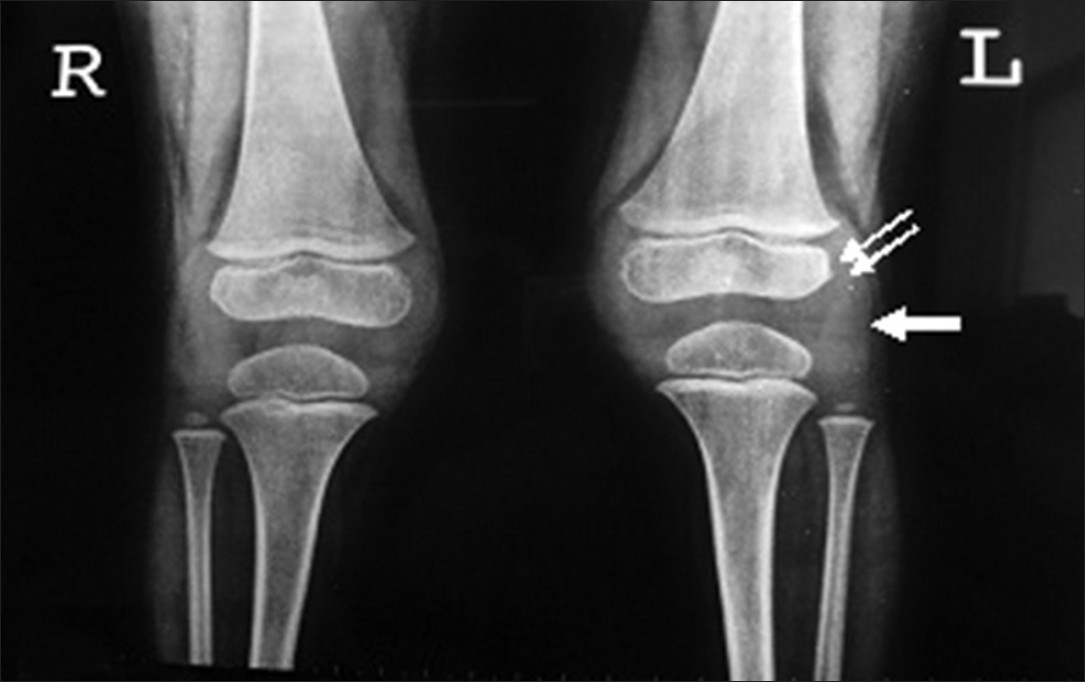 Three-year 3-month-old girl child with CACP syndrome. Plain AP radiograph of both knees shows periarticular osteopenia, apparent widening of the joint space the result of effusions (arrow) and enlargement of the epiphyses secondary to the hyperaemia (double arrows). Note the absence of joint erosions.