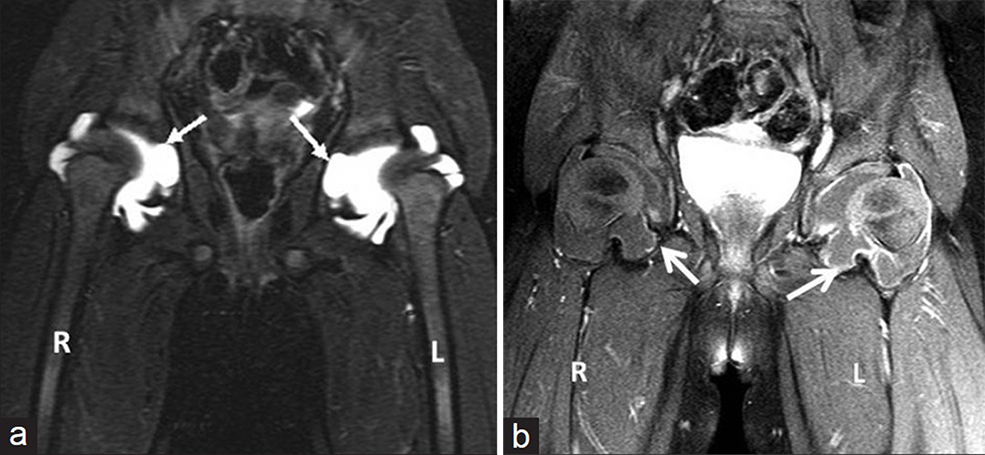 (a) Three-year 3-month-old girl child with CACP syndrome. Coronal STIR image of hips (on 3T system) shows large bilateral joint effusions. Note the intra-osseous acetabular herniations communicating with the effusions (arrows) and (b) 3-year 3-month-old girl child with CACP syndrome. Coronal T1-weighted image of hips (on 3T system) obtained after administration of gadolinium shows rim enhancement of joint capsule (better appreciated on the left side) and of walls of intraosseous herniations (arrows). Note the lack of thick solid synovial enhancement as seen in Juvenile idiopathic arthritis.