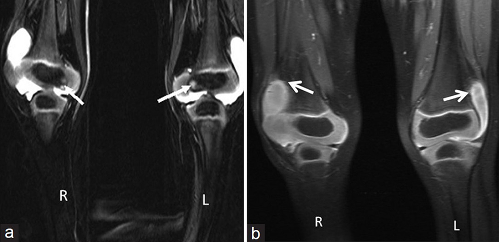 (a) Three-year 3-month-old girl child with CACP syndrome. Coronal STIR image of both knees (on 3T system) shows large effusions. Small intraosseous cysts are identified along the medial femoral condyle (arrows) and (b) 3 year 3 month old girl child with CACP syndrome. Coronal T1 weighted of both knees (on 3T system) shows effusion with mildly thickened synovium (arrows).