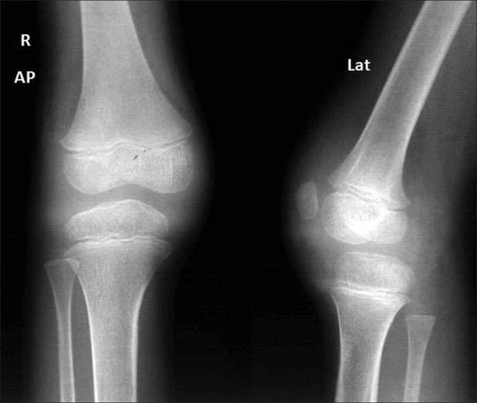 Three-year 3-month-old girl child with CACP syndrome. Coronal STIR image of both knees (on 3T system) shows large effusions. Small intraosseous cysts are identified along the medial femoral condyle (arrows)