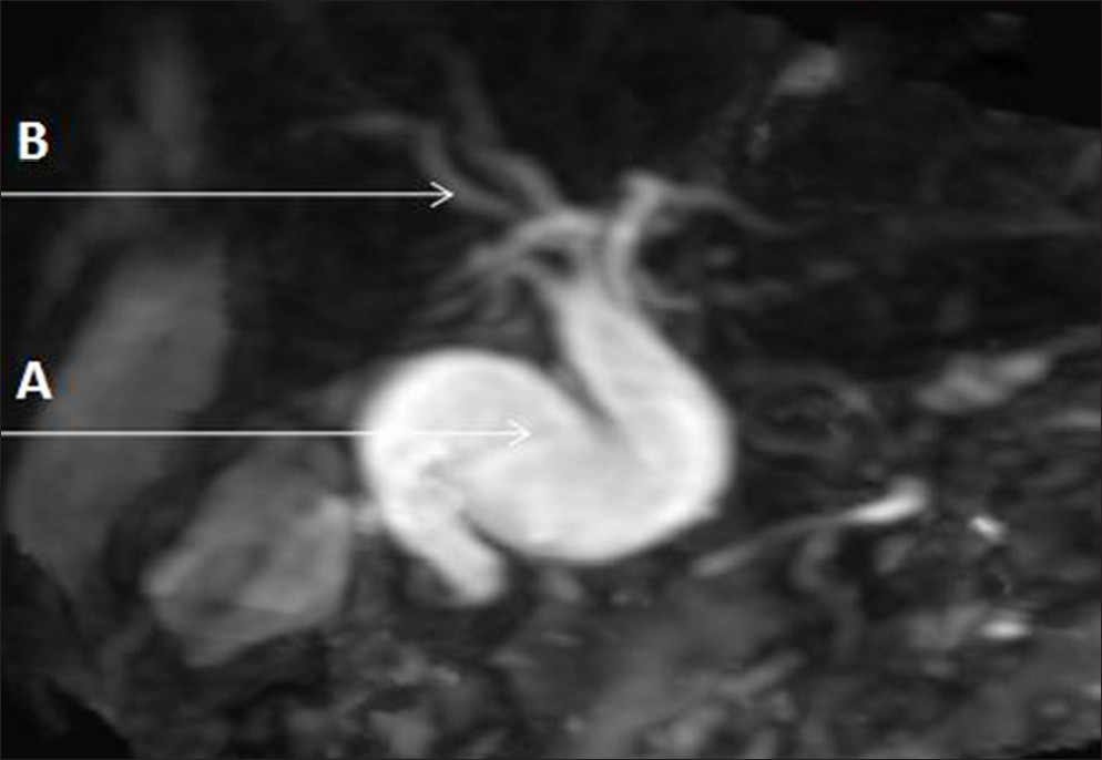 Case 1: One-and-half-year-old male child diagnosed as having spontaneous biliary peritonitis. Magnetic resonance cholangio-pancreatography image shows grossly dilated common bile duct (A) and dilatation of intra hepatic biliary radicals (B).