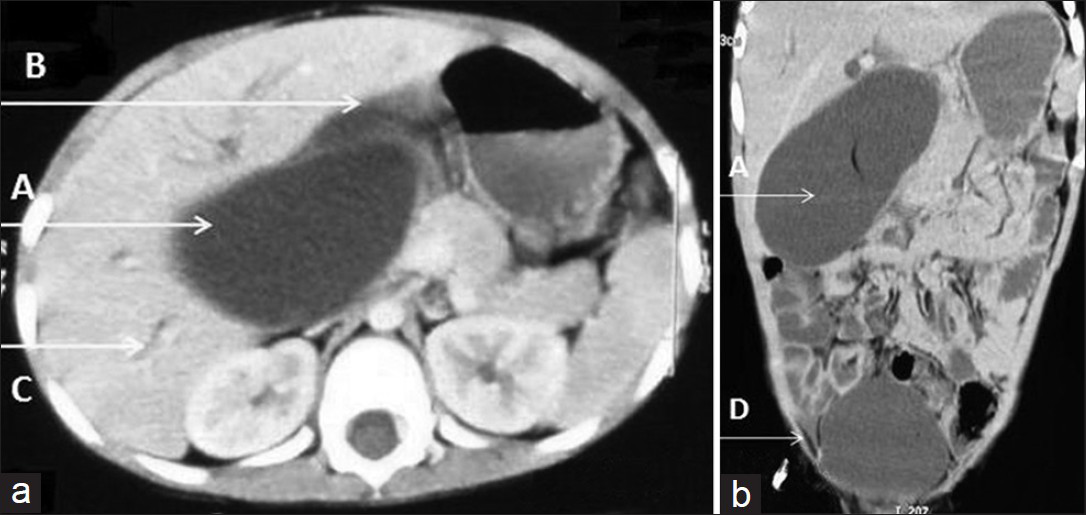 Case 2: Three-year-old male child with abdominal pain and high-grade intermittent fever, mild jaundice without cholestatic features, vomiting, and a lump in the right upper abdomen later diagnosed as having spontaneous biliary peritonitis. (a) Contrast enhanced computed tomography axial section demonstrates dilated gallbladder crossing the midline (A), free fluid in left sub hepatic space (B), and dilated intra hepatic biliary radicals, (b) Contrast enhanced computed tomography axial section multiplanar reconstructed coronal image demonstrates dilated GB crossing midline (A) and free fluid in pelvis (D).