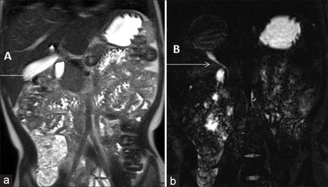 Case 2: 3-year-old male child diagnosed as having spontaneous biliary peritonitis. (a) Follow-up T2-weighted magnetic resonance cholangio- Pancreatography image shows normally distended Gall Bladder (A), (b) Follow-up T2-weighted fat suppressed cholangio-pancreatography image of case 2 shows normal caliber common Bile duct (B).