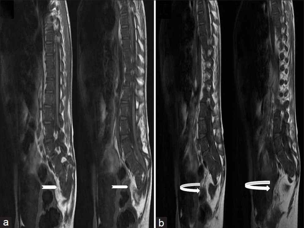 Ten-year-old girl diagnosed with Group II Caudal regression syndrome. (a and b) Sagittal T1 weighted images show bilateral sacral agenesis (white arrow, S2 level) with anterior lipomyelocystocele (curved white arrow).