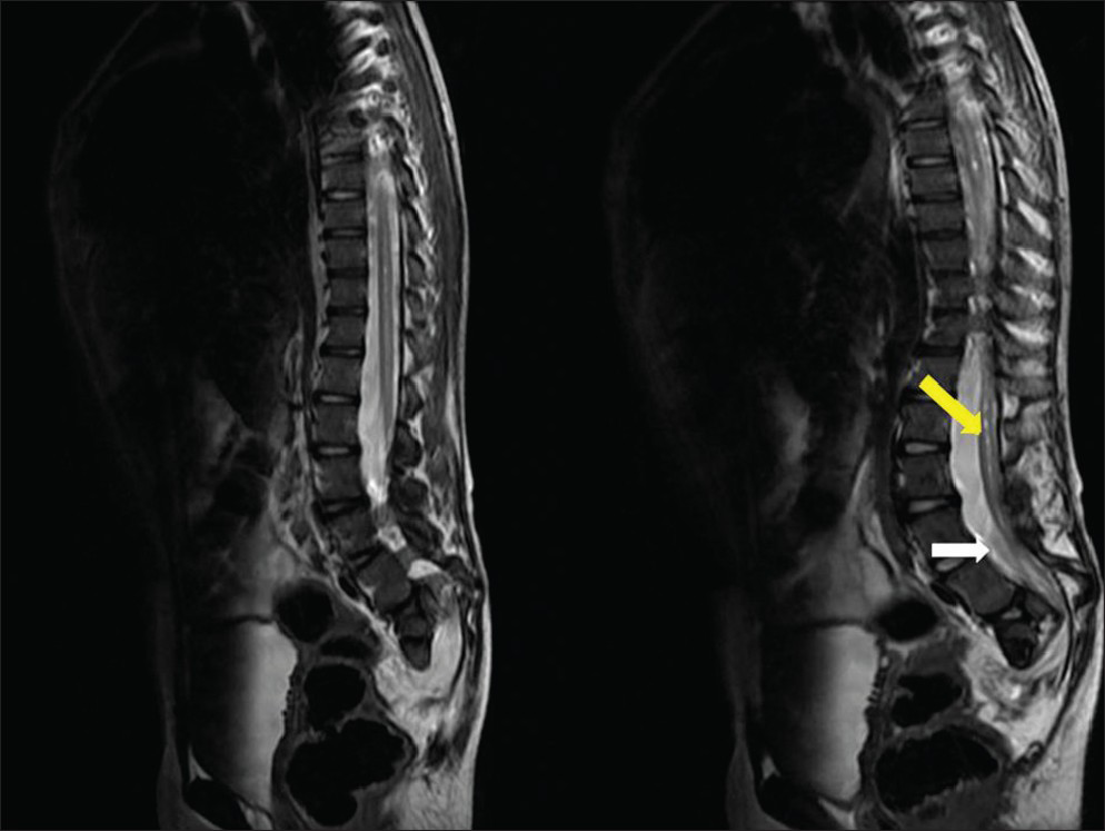 sirenomelia syndrome x ray