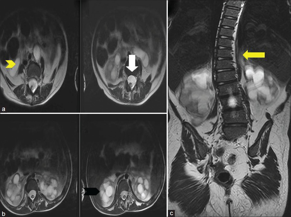 Ten-year-old girl diagnosed with Group II Caudal regression syndrome. (a) Axial T2 weighted image shows anterior epidural lipoma (white arrow). (b) Axial T2 weighted image shows bilateral hydronephrosis (black arrowhead) and bilateral hydroureter (yellow arrowhead). (c) Coronal T2 weighted image reveals lumbosacral scoliosis (yellow arrow).