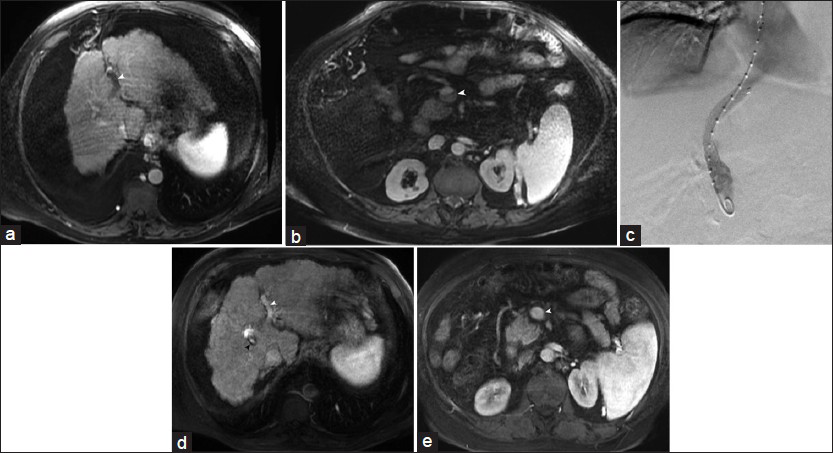 63-year-old man with portal vein and superior mesenteric vein thrombosis. (a and b) Contrast-enhanced axial magnetic resonance images reveal left intrahepatic portal vein thrombosis (arrowhead) and nonocclusive superior mesenteric vein clot (arrowhead). (c) Digital subtraction venogram performed after 10 mm transjugular intrahepatic portosystemic shunt creation demonstrates widely patent shunt. (d and e) Contrast-enhanced magnetic resonance images taken 4-months later displays complete recanalization of left portal vein and superior mesenteric vein (white arrowheads). Black arrowhead in (d) indicates patent transjugular intrahepatic portosystemic shunt.