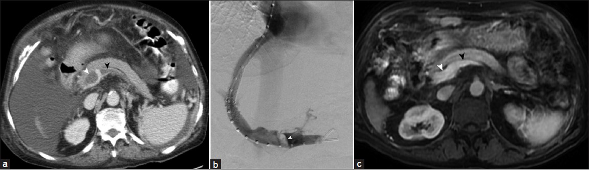 69-year-old woman with portal vein and splenic vein thrombosis. (a) Contrast -enhanced axial computed tomography image reveals nonocclusive thrombus at portal confluence (white arrowhead) and within splenic vein (black arrowhead). (b) Digital subtraction venogram performed after 10 mm transjugular intrahepatic portosystemic shunt creation demonstrates patent shunt, and shows presence of filling defect at portal confluence (arrowhead). (c) Contrast enhanced magnetic resonance images taken 6-months later displays complete recanalization of portal vein (white arrowhead) and splenic vein (black arrowhead).