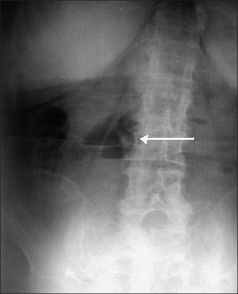 74-year-old female patient with sudden onset of abdominal pain, nausea, and vomiting diagnosed with jejunal diverticulosis and perforation. Upright abdominal X-ray image shows small bowel obstruction and air-fluid area (arrow).