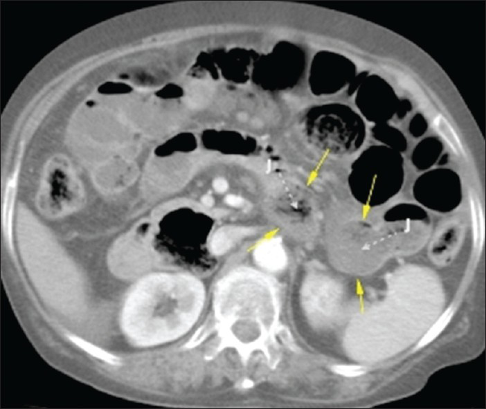 74-year-old female patient with sudden onset of abdominal pain, nausea, and vomiting diagnosed with jejunal diverticulosis and perforation. Contrast-enhanced abdominal CT image shows two jejunal diverticula (arrows). Direction of the diverticula from their origin is shown with dashed white arrows (J: Jejunum).