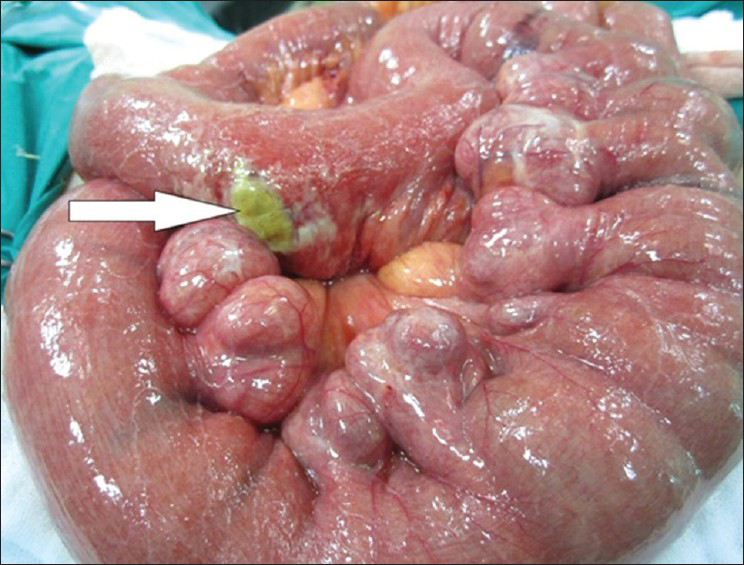 74-year-old female patient with sudden onset of abdominal pain, nausea, and vomiting diagnosed with jejunal diverticulosis and perforation. Photograph taken during abdominal exploration, shows multiple diverticula on the mesenteric side of the jejunum, and a perforation hole due to necrosis on one of the di verticula in the distal part (arrow).