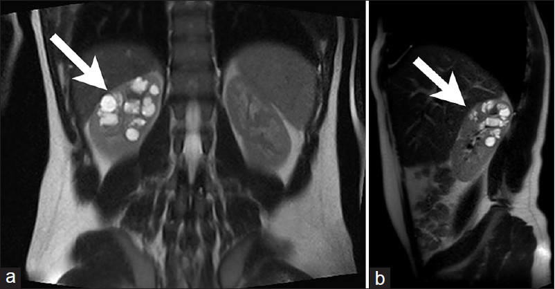 16-year-old male with high blood pressure for over 2 years diagnosed with localized cystic disease of the kidney. T2 weighted (a) coronal and (b) sagittal MR images show the upper pole of the right kidney is filled with multiple, round, well marginated cysts of various sizes without capsule formation (arrow).