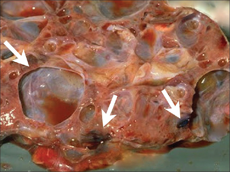 16 year old male with high blood pressure for over 2 years diagnosed with localized cystic disease of the kidney. Gross image of the partial nephrectomy specimen shows multiple well demarcated cysts of various sizes (arrows). They contain dark brown or clear serous fluid.
