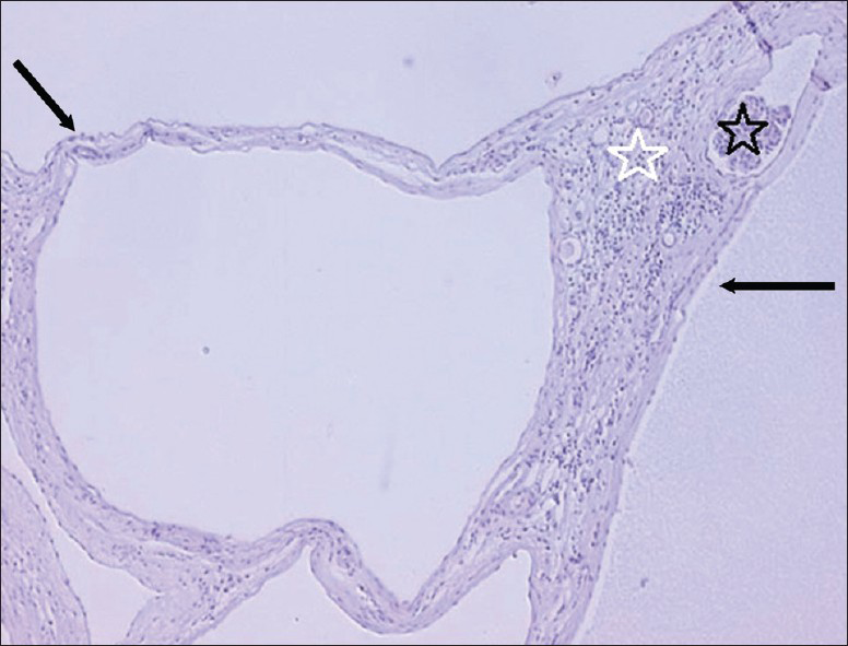 16 year old male with high blood pressure for over 2 years diagnosed with localized cystic disease of the kidney. Periodic acid schiff stained (×10) nephrectomy specimen reveals cysts lined largely by a simple low is cuboidal epithelium (black arrows). There are no papillary areas. Hemorrhage noted in the cyst (black star) and inflammatory reaction in which macrophages are prominent is also noted, the intervening tissue between the cysts (white star) contains compressed glomeruli and tubules. The tubules are mature and no blastema or immature fetal elements are identified.
