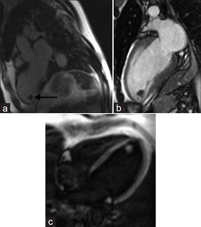 69-year-old male with chest pain diagnosed with left ventricular thrombus. (a-c) MR of the heart: (a) Delayed-enhancement inversion recovery sequence demonstrates a hypointense mass (black arrow) at the apex of the left ventricle. (b) SSFP cine imaging reveals hypokinesis of the left ventricular wall in this region, and (c) Cine of the left ventricle with different inversion times differentiates the mass from normal myocardium. Findings are diagnostic of left ventricular thrombus.