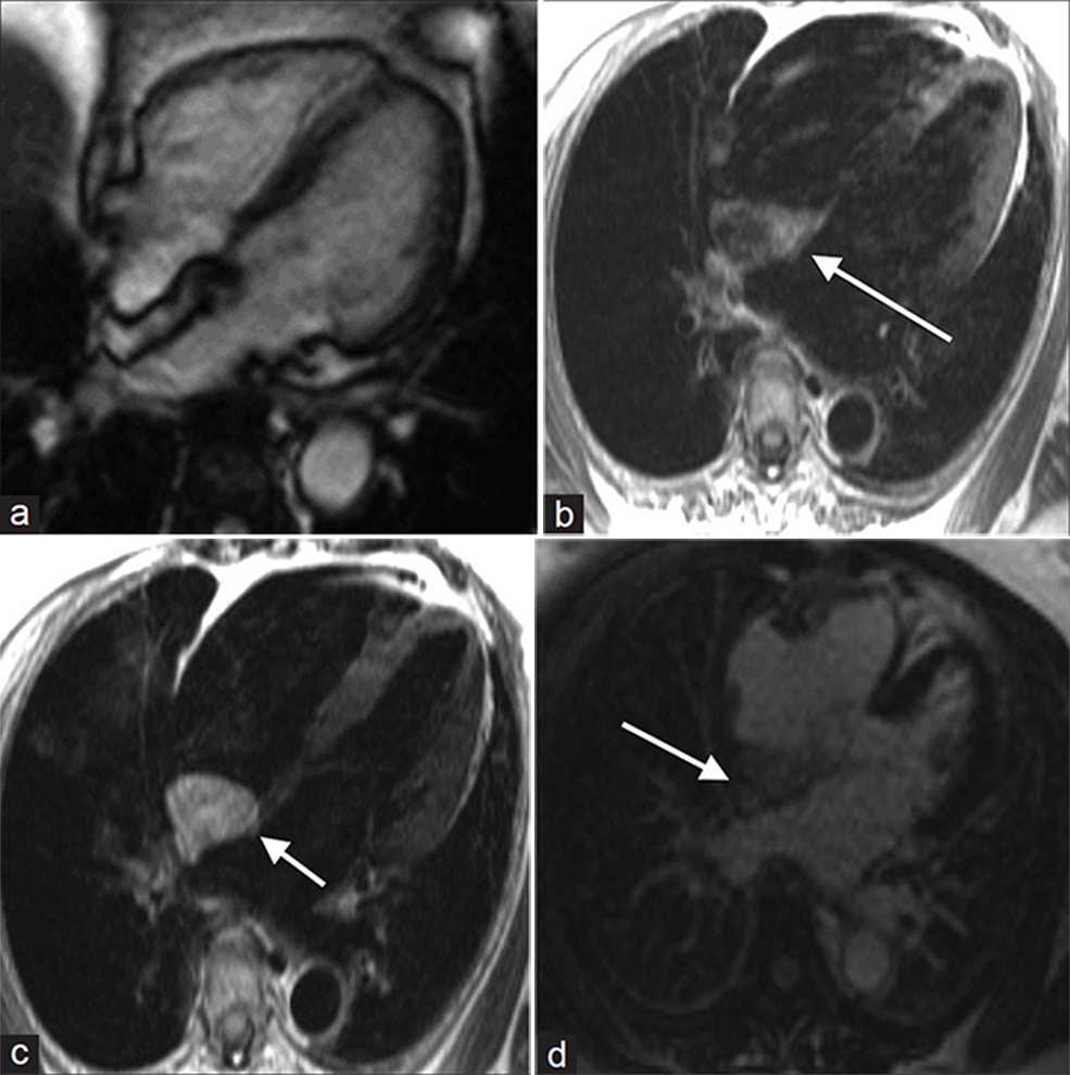 55-year-old male with dyspnea on exertion diagnosed with lipomatous hypertrophy. (a-d) MR of the heart: (a) Steady-state free precession (SSFP) cine demonstrates a non-contractile, non-encapsulated hyperintense inter-atrial septal thickening, (b) T1-weighted, (c) T2-weighted, and (d) without enhancement images show hyperintense signal in the area of thickening (white arrows). Findings are compatible with lipomatous hypertrophy.