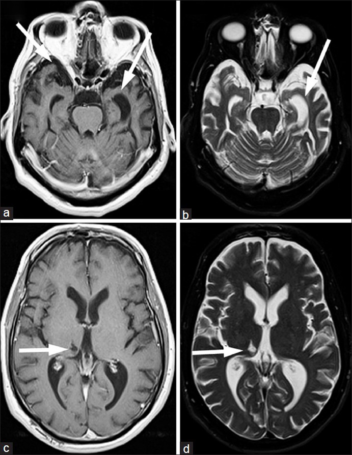 61-year-old male with change in mental status and decline in function diagnosed with semantic dementia. (a and b) The magnetic resonance imaging (MRI) transaxial views of the T1-weighted and (c and d) T2-weighted images with proton density and fluid suppression sequences demonstrate diffuse parenchymal atrophy, slightly more substantial in the temporal lobes (arrows on a and c). These non-specific findings do raise the possibility of frontotemporal dementia (FTD). A thalamic infarct (arrows on b and d), along with subtle white matter abnormalities are also seen, which are suggestive of vascular dementia, though inconsistent with the negative magnetic resonance angiography findings.