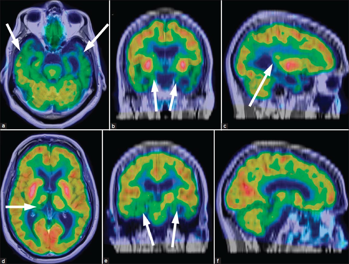 61-year-old male with change in mental status and decline in function diagn¬osed with semantic dementia. The fluorine-18 fluorodeoxyglucose (F-18 FDG) positron emission tomography (PET) of the brain was obtained and coregistered with the T1-weighted sequences of the MRI. Two separate triangulated cross-sections of the reconstructed images in (a and d) axial views, (b and e) coronal views, and (c and f) sagittal dimensions show significantly reduced uptake corresponding to atrophy in the temporal lobes (arrows on a), involving the amygdalae (arrows on b), hippocampi (arrows on e), and Wernicke's area (arrow on c). The function is well preserved in the remaining areas of global atrophic change and white matter changes. There is also reduced activity in the location of the suspected right thalamic infract (arrow d). These findings are pathognomonic for semantic dementia.