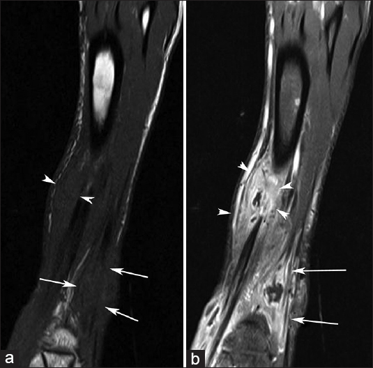 33-year-old man with painful swelling in the right ankle diagnosed with tuberculous tenosynovitis. (a) Pre-contrast and (b) post-contrast coronal T1-weighted images with gadolinium enhancement show tenosynovitis in the distal portion of the lower limb – thickening of the extensor digitorum longus (white arrows) and anterior tibial (arrow heads) tendons.