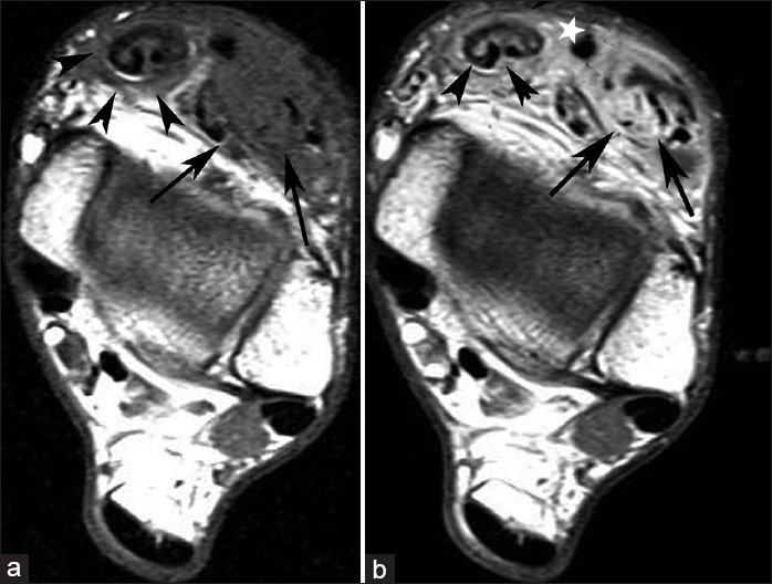 33-year-old man with painful swelling in the right ankle diagnosed with tuberculous tenosynovitis. (a) Pre-contrast and (b) post-contrast Axial T1-weighted images at the level of the right tibiotalar joint demonstrate contrast enhancement of the extensor digitorum longus (black arrows) and tibialis anterior tendons (arrow heads) and surrounding smooth tissue. The extensor hallucis longus tendon is normal (white star).