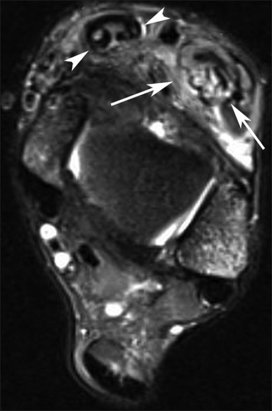 33-year-old man with painful swelling in the right ankle diagnosed with tuberculous tenosynovitis. Axial fat-suppressed T2-weighted MR images at the level of the right tibiotalar joint shows thickening of the extensor digitorum longus (arrows) and tibialis anterior tendons (arrow heads), peritendinous edema and minimal fluid within the synovial sheath, edema in the surrounding subcutaneous tissues with loss of fat planes and increased signal intensity within the tendons.