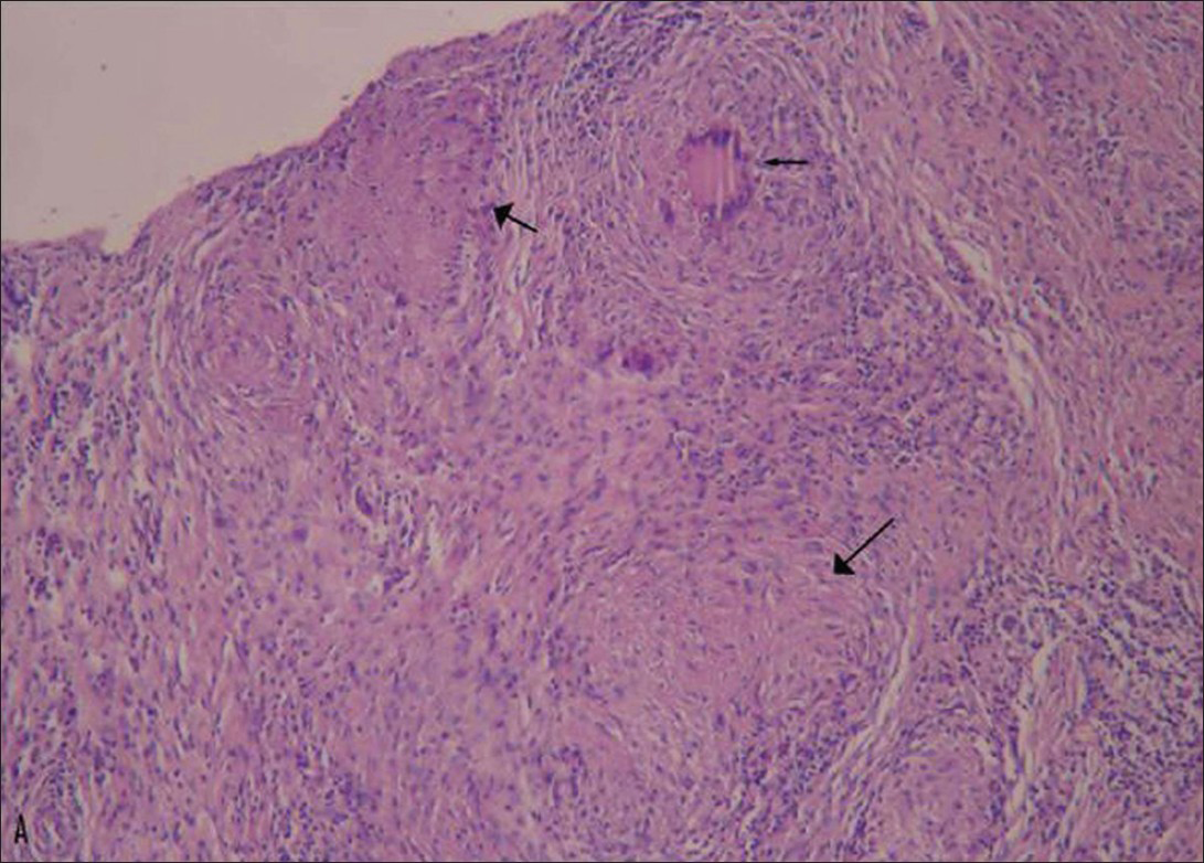 33-year-old man with painful swelling in the right ankle diagnosed with tuberculous tenosynovitis. Photomicrograph of a histopathological section of the synovium stained with hematoxylin-eosin (×100) shows casseous necrosis with granuloma formation (black arrow), typical of tuberculosis infection.