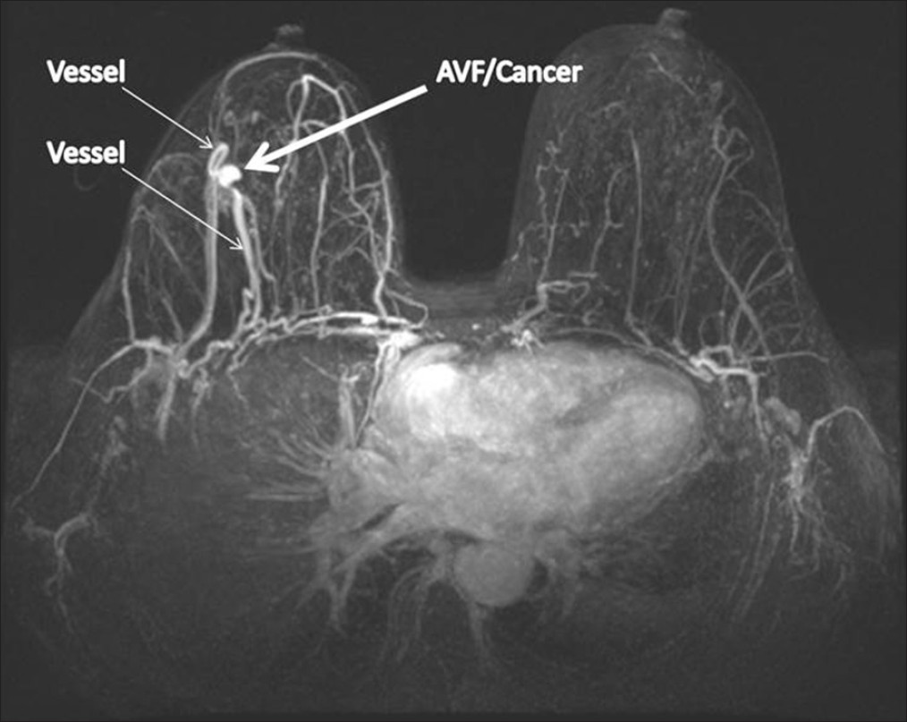 58-year-old female diagnosed with arteriovenous fistula of the right breast with adjacent invasive ductal carcinoma. Axial maximum intensity projections magnetic resonance image demonstrates an arterially enhancing mass (thick arrow) with prominent feeding and draining vessels (thin arrows).
