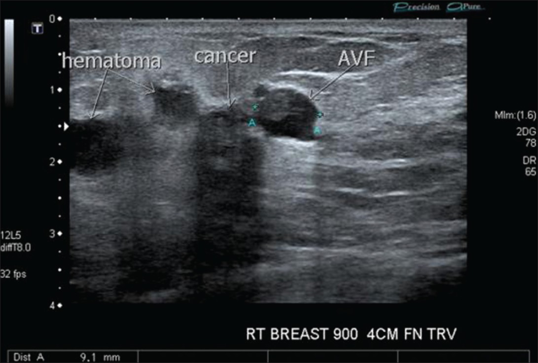 Acquired Arteriovenous Fistula of the Breast Following Ultrasound ...