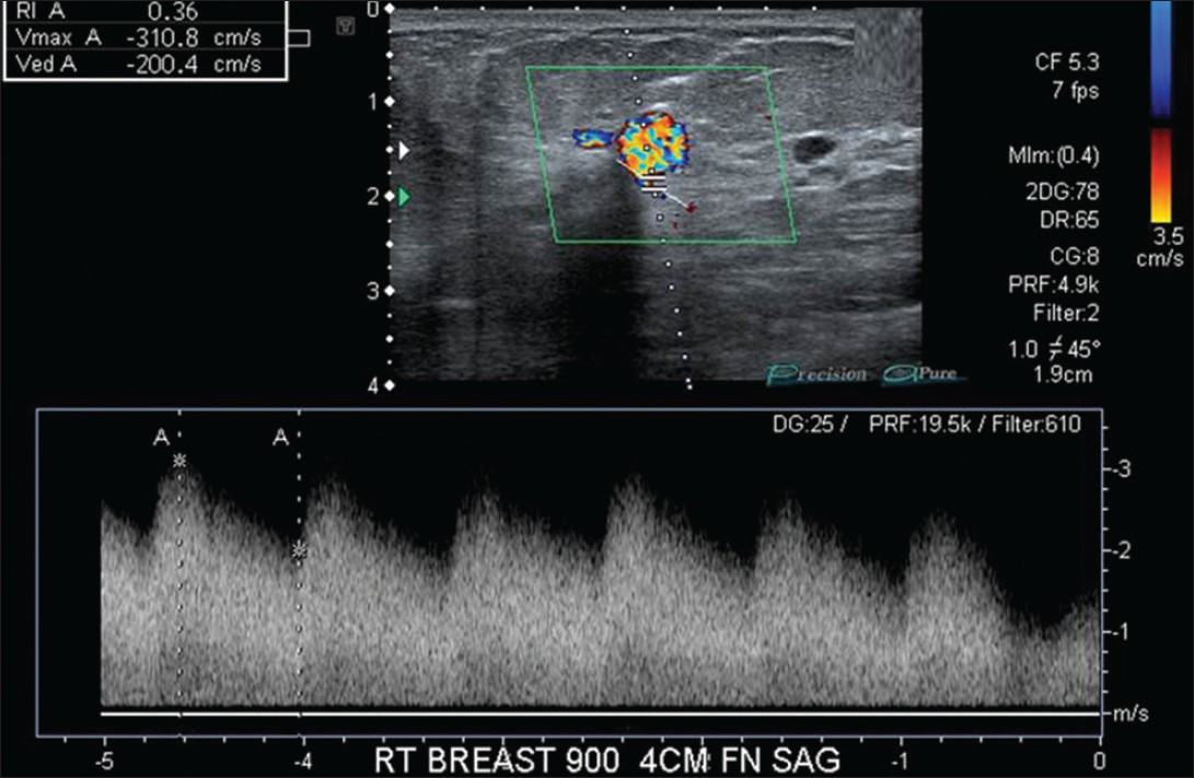 58-year-old female diagnosed with arteriovenous fistula (AVF) of the right breast with adjacent invasive ductal carcinoma. Sagittal color Doppler sonogram with spectral waveform imaging shows high velocity, low resistance wave forms within the AVF.