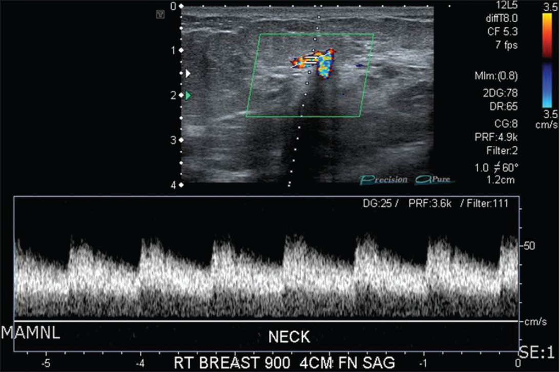 58-year-old female diagnosed with arteriovenous fistula of the right breast with adjacent invasive ductal carcinoma. Sagittal color Doppler sonogram with spectral waveform imaging shows arterialization of the draining vein.