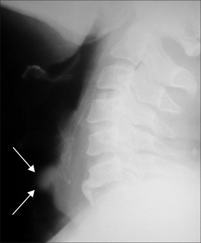 42-year-old man diagnosed with adenoid cystic carcinoma. Lateral radiograph of neck shows a broad-based polypoidal mass arising from the posterior wall of proximal end of trachea causing luminal narrowing (arrows).