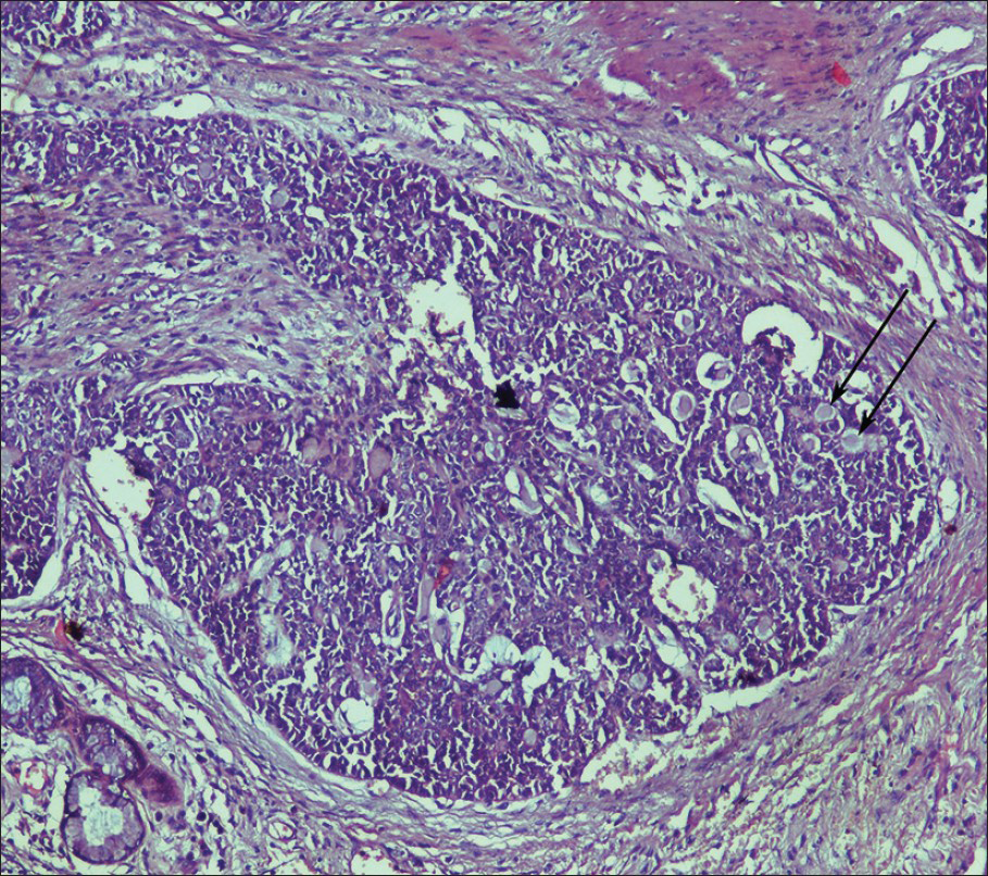 42-year-old man diagnosed with adenoid cystic carcinoma. High magnification (hematoxylin and eosin, ×100) photomicrograph of stained biopsy specimen shows neoplastic, moderately uniform round cells with hyperchromatic nuclei arranged in typical cribriform pattern of growth (arrows).