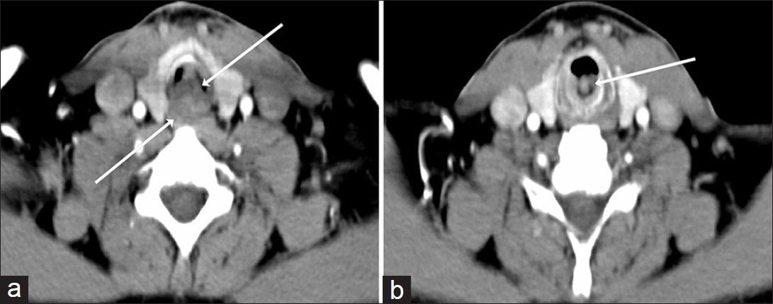 42-year-old man diagnosed with adenoid cystic carcinoma. (a) Contrast-enhanced axial computed tomography (CT) scan of neck shows a broad-based soft tissue mass (arrows) arising from posterior wall of upper end of trachea with both intraluminal and extraluminal components. Less than 180 degree circumference of trachea is involved. (b) CT scan obtained at the level of cricoid cartilage shows extension of tumor to subglottis (arrow).