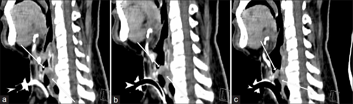 A 42-year-old man diagnosed with adenoid cystic carcinoma. Serial sagittal reformatted CT images (a-c) of neck show longitudinal extent of tumor (arrows) located at upper end of trachea extending to subglottis with both intraluminal and extraluminal components. Tracheostomy tube is seen inferior to the mass (arrowhead).