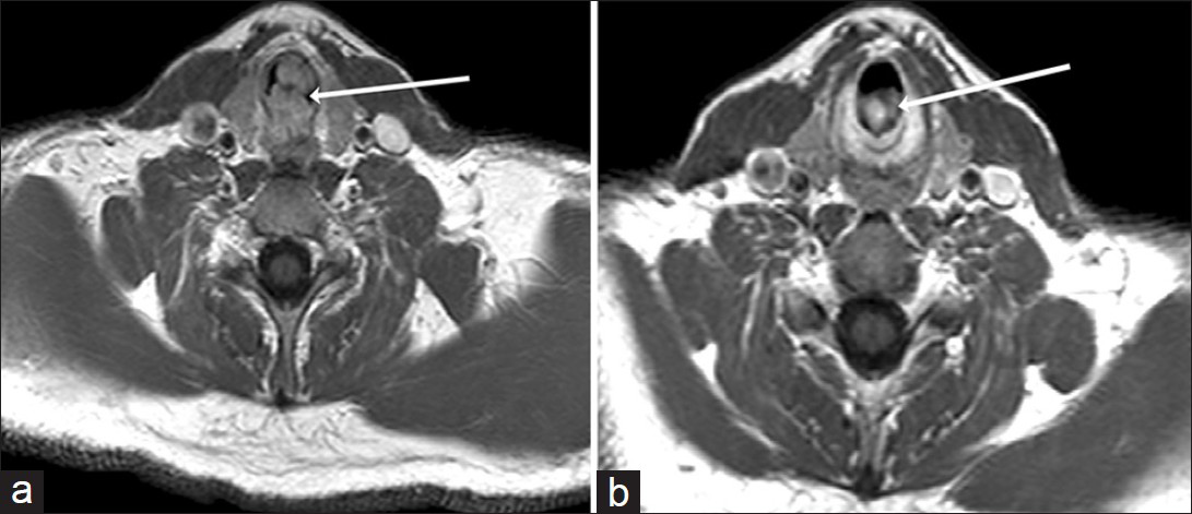 42-year-old man diagnosed with adenoid cystic carcinoma. (a) Axial magnetic resonance post-contrast T1-weighted image of neck shows broad-based soft tissue mass (arrow) arising from posterior wall of upper end of trachea causing near total luminal narrowing and having both intraluminal and extraluminal components. (b) Magnetic resonance image obtained at the level of cricoid cartilage shows extension of tumor to subglottis.