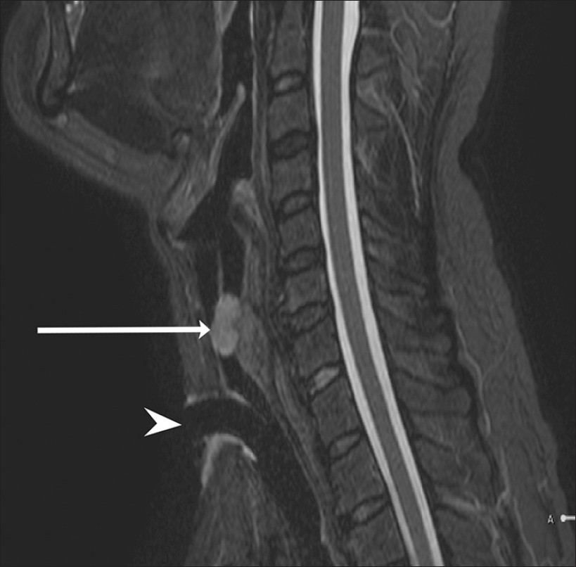 42-year-old man diagnosed with adenoid cystic carcinoma. Sagittal magnetic resonance Short Tau Inversion Recovery image of neck shows longitudinal extent of tumor (arrow) located at the level of upper end of trachea extending to subglottis causing almost complete luminal narrowing. Tracheostomy tube is seen below the level of tumor (arrowhead).