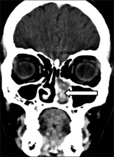 46-year-old female with intermittent episodes of nasal bleeding diagnosed with lobular capillary hemangioma. Computed tomography of paranasal sinuses, coronal section, shows a lobulated well-circumscribed soft-tissue mass (white arrow) filling the left nasal cavity.