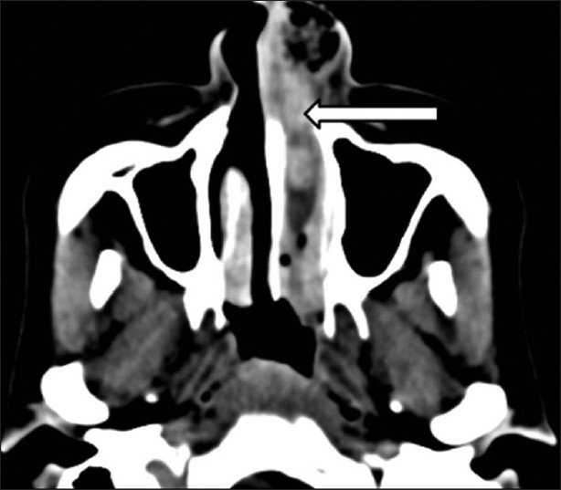 46-year-old female with intermittent episodes of nasal bleeding diagnosed with lobular capillary hemangioma. Contrast enhanced computed tomography of paranasal sinuses, axial section shows a lobulated well-circumscribed intensely enhancing soft-tissue mass (white arrow) filling the left nasal cavity.