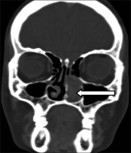 46-year-old female with intermittent episodes of nasal bleeding diagnosed with lobular capillary hemangioma. Computed tomography of paranasal sinuses (coronal section) bone window reveals the lesion (white arrow) is closely attached to the nasal septum with no underlying destruction or remodeling of the underlying bones.