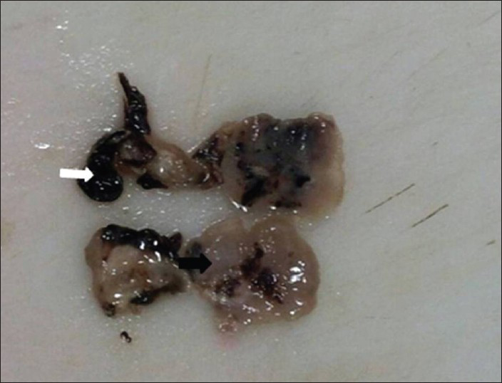 46-year-old female with intermittent episodes of nasal bleeding diagnosed with lobular capillary hemangioma. Gross specimen obtained after excisional biopsy of nasal mass from nasal septum shows polypoidal gelatinous tissue bits (black arrow) along with areas of hemorrhage (white arrow).