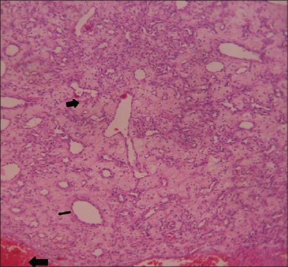 46-year-old female with intermittent episodes of nasal bleeding diagnosed with lobular capillary hemangioma. Hematoxylin and eosin stained tissue (×10) reveals lobules of small capillaries lined by flattened endothelium (thin black arrow) filled with blood, the surrounding stroma shows hemorrhage (thick black arrow) at places