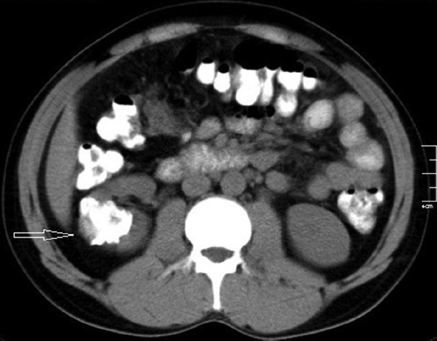 32-year-old male with left flank pain and gross hematuria diagnosed with renal medullary fibroma. Unenhanced computed tomography scan of the abdomen reveals a calcified, partially exophytic soft-tissue mass (arrow) involving the mid and interpolar regions of the right kidney.