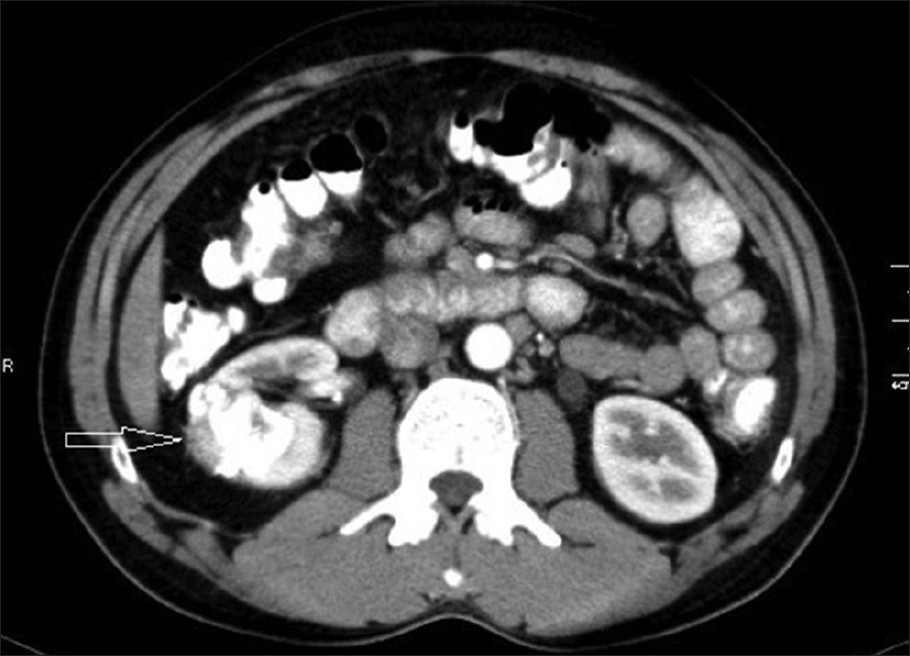32-year-old male with left flank pain and gross hematuria diagnosed with renal medullary fibroma. Contrast enhanced computed tomography reveals doubtful enhancement around the calcified partially exophytic mass with perirenal mild inflammatory stranding (arrow).