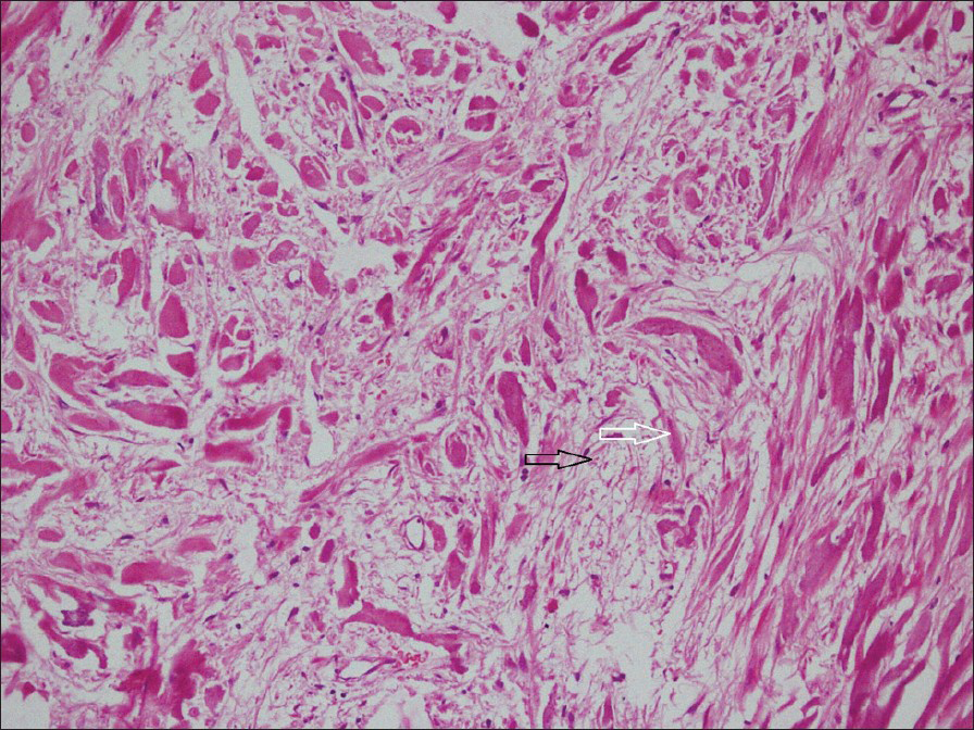 32-year-old male with left flank pain and gross hematuria diagnosed with renal medullary fibroma. Photomicrograph of hematoxylin and eosin, stained tissue (×100) shows bland spindle-shaped cells occurring singly within a loose stromal matrix (black arrow) and separated by thick collagen bundles (white arrow).