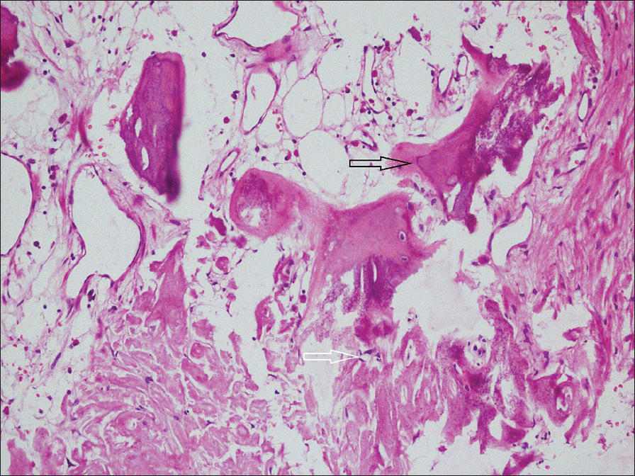 32-year-old male with left flank pain and gross hematuria diagnosed with renal medullary fibroma. Photomicrograph of H and E stained tissue (×100) shows foci of thick collagen bundles with calcification (white arrow) and osseous metaplasia (black arrow).