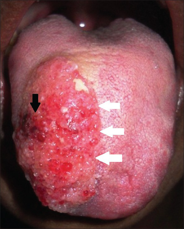 29-year-old female with swelling on the right side of her tongue diagnosed as lymphangioma circumscriptum. Intra-oral picture frontal view shows pebbly, vesicle-like feature with so-called “frog-egg” or “tapioca-pudding” appearance (black arrow) and medially extends till midline of tongue (white arrows).