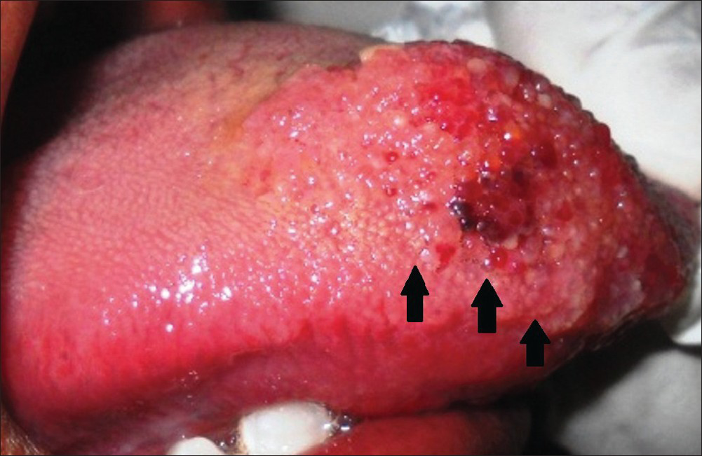 29-year-old female with swelling on the right side of her tongue diagnosed as lymphangioma circumscriptum. Intra-oral picture lateral view shows that the lesion laterally extends till the lateral borders of the tongue (black arrows).