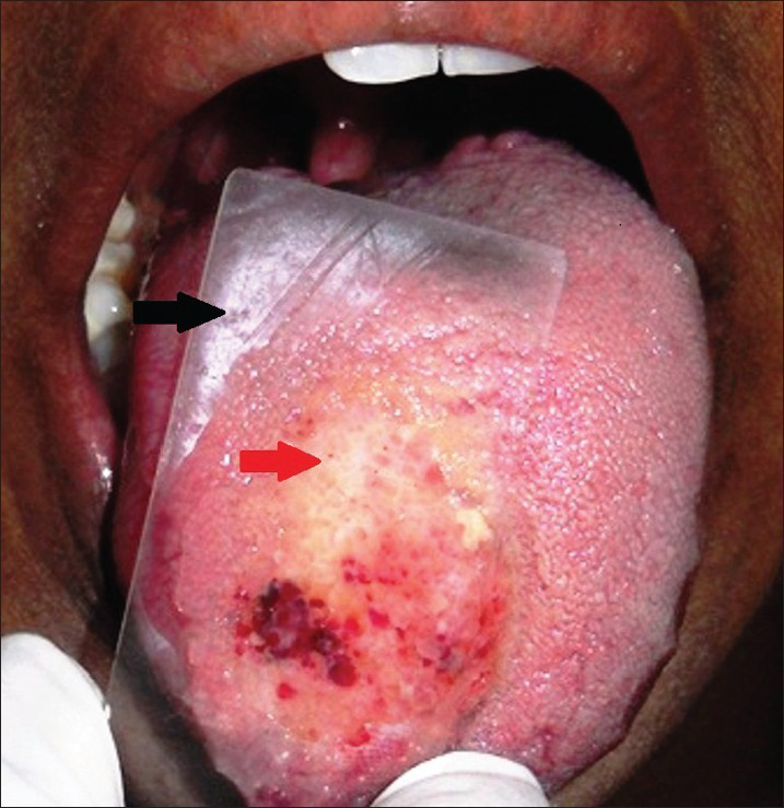 29-year-old female with swelling on the right side of her tongue diagnosed as lymphangioma circumscriptum. Diascopy test performed by pressing a glass slide (black arrow) on the lesion results in blanching (red arrow) which suggests that lesion could be a vascular lesion.